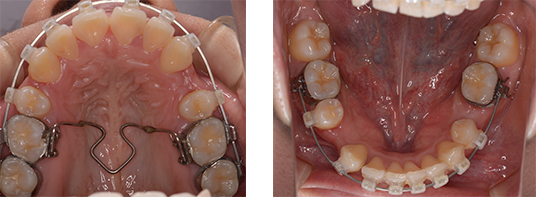 ブラケット治療の際に抜糸を行った人の口中画像